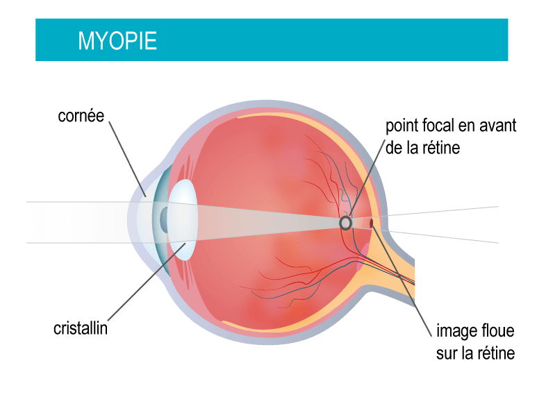 oeil-myopie-explication